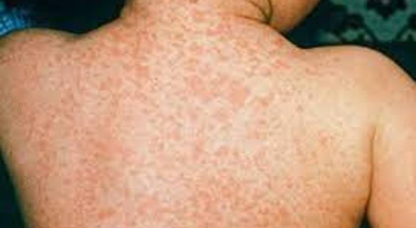 measles spread to adjacent panchayats