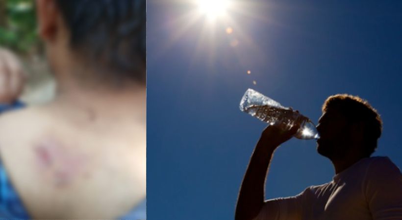 Youth got sun burn at Palakkad