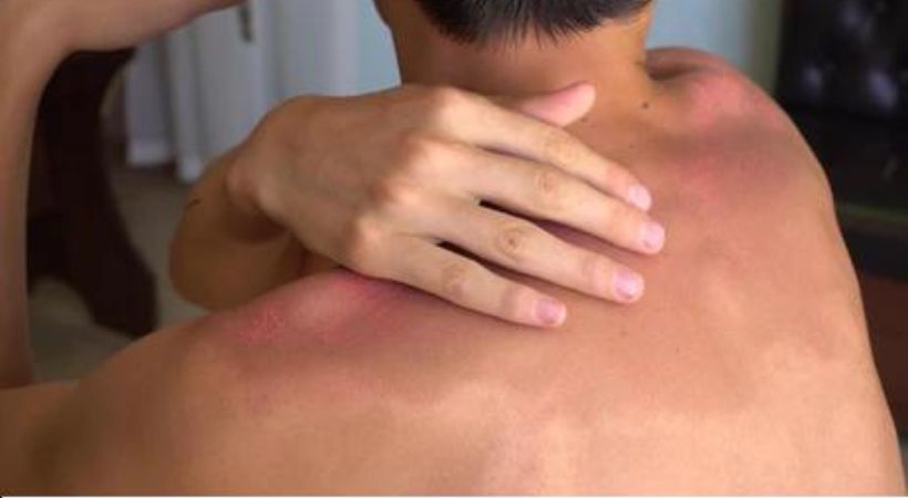 What is sun burn and how it is affected your skin