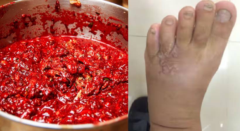 Parasitic worms underneath skin after eating blood pudding