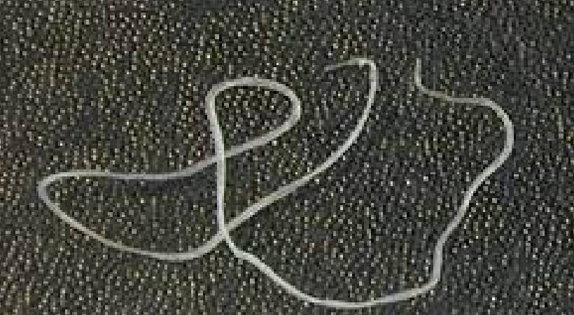 11cm long dirofilarial worm found in human eye