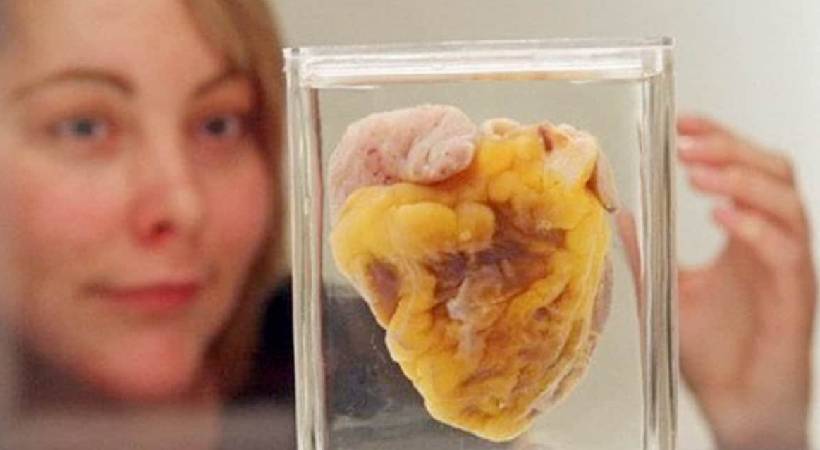 Transplant patient sees own heart display at museum