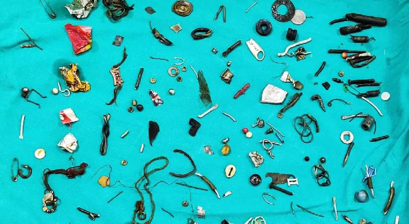 Man Complains Of Stomach Pain For Years Doctors Find bizzare items inside Body