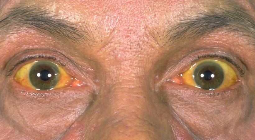 jaundice grips thrikakkara