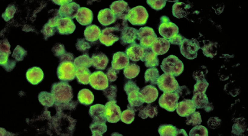 14-year-old boy cured of amoebic meningoencephalitis