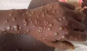 m pox