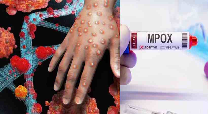 mpox