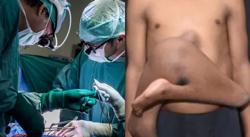 Doctors at AIIMS Delhi Perform Surgery on Teen with Rare Parasitic Twin Condition