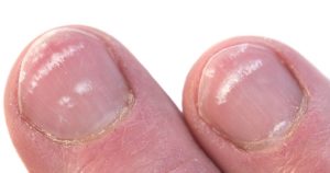 white spots in nails