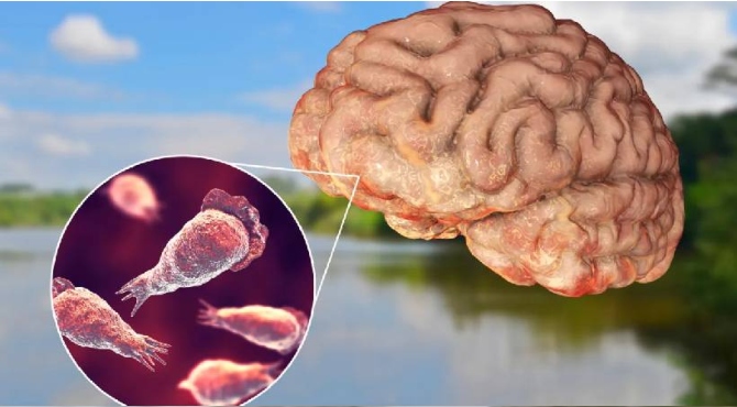 Amebic encephalitis